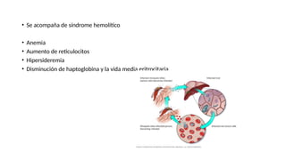 • Se acompaña de síndrome hemolítico
• Anemia
• Aumento de reticulocitos
• Hipersideremia
• Disminución de haptoglobina y la vida media eritrocitaria
 