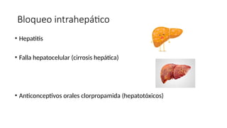 Bloqueo intrahepático
• Hepatitis
• Falla hepatocelular (cirrosis hepática)
• Anticonceptivos orales clorpropamida (hepatotóxicos)
 