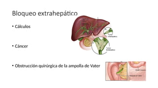 Bloqueo extrahepático
• Cálculos
• Cáncer
• Obstrucción quirúrgica de la ampolla de Vater
 