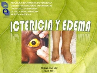 REPÚBLICA BOLIVARIANA DE VENEZUELA UNIVERSIDAD NACIONAL EXPERIMENTAL “FRANCISCO DE MIRANDA” CS. DE LA SALUD MEDICINAPRÁCTICA MÉDICA I ICTERICIA Y EDEMA ARIANA JIMÉNEZ JULIO 2011 