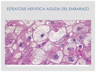ESTEATOSIS HEPÁTICA AGUDA DEL EMBARAZO
 