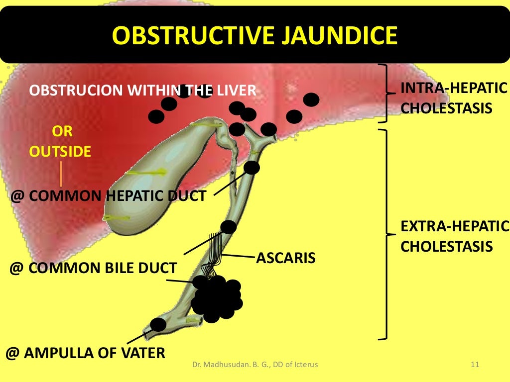 Differential Diagnosis of Icterus/Jaundice
