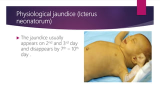 Physiological jaundice (Icterus
neonatorum)
 The jaundice usually
appears on 2nd and 3rd day
and disappears by 7th – 10th
day .
 
