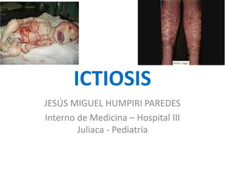 ICTIOSIS
JESÚS MIGUEL HUMPIRI PAREDES
Interno de Medicina – Hospital III
Juliaca - Pediatría
 
