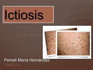Ictiosis 
Pemeli María Hernández 
1045213 
 