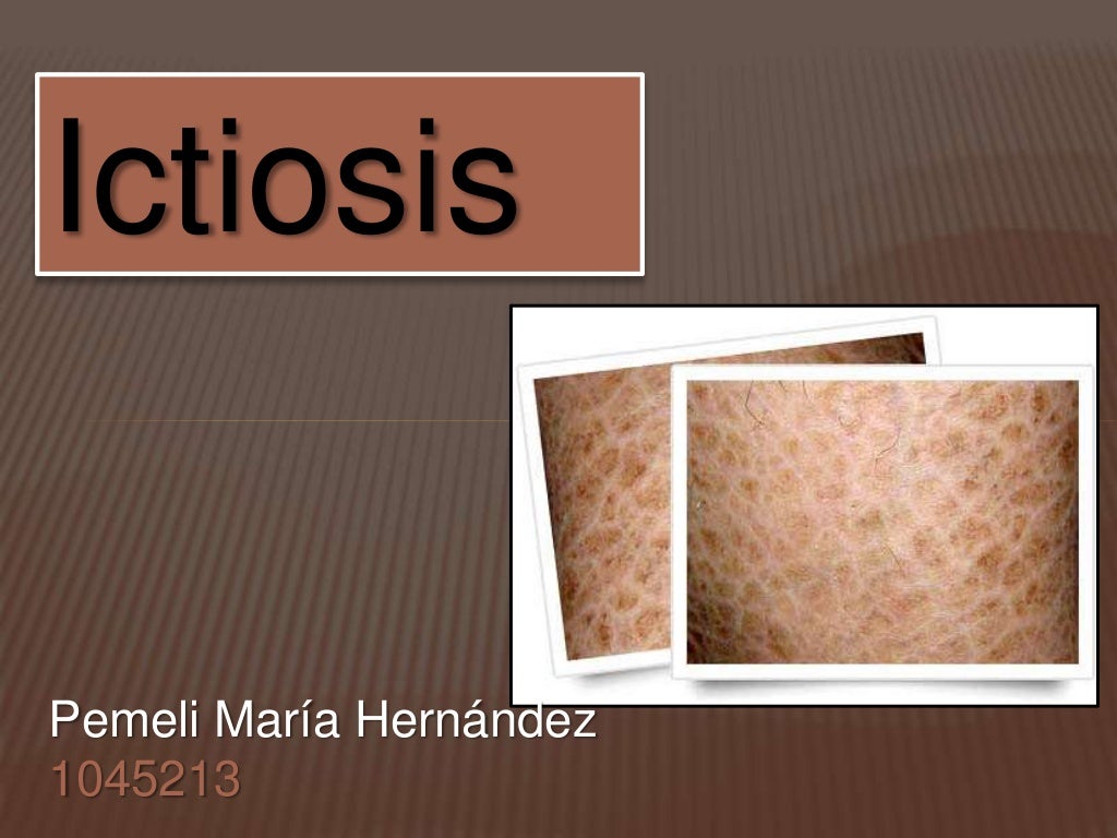 ictiosis