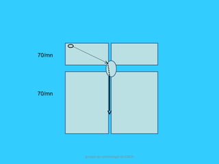 groupe de rythmologie du CNCH
70/mn
70/mn