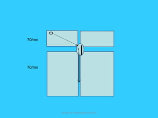 groupe de rythmologie du CNCH
70/mn
70/mn