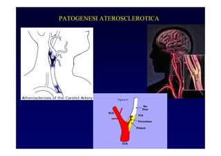 PATOGENESI ATEROSCLEROTICA
 
