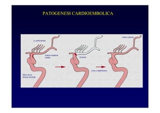 PATOGENESI CARDIOEMBOLICA
 