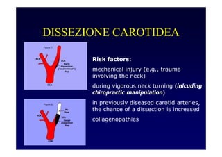 DISSEZIONE CAROTIDEA
Risk factors:
mechanical injury (e.g., trauma
involving the neck)
during vigorous neck turning (inlcuding
chiropractic manipulation)
in previously diseased carotid arteries,
the chance of a dissection is increased
collagenopathies
 