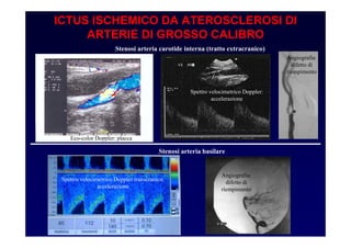 ICTUS ISCHEMICO DA ATEROSCLEROSI DI
ARTERIE DI GROSSO CALIBRO
Stenosi arteria carotide interna (tratto extracranico)
Stenosi arteria basilare
Eco-color Doppler: placca
Spettro velocimetrico Doppler:
accelerazione
Angiografia:
difetto di
riempimento
Angiografia:
difetto di
riempimento
Spettro velocimetrico Doppler transcranico:
accelerazione
 