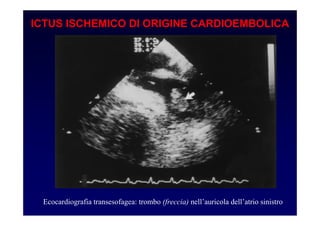 ICTUS ISCHEMICO DI ORIGINE CARDIOEMBOLICA
Ecocardiografia transesofagea: trombo (freccia) nell’auricola dell’atrio sinistro
 