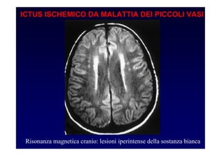 ICTUS ISCHEMICO DA MALATTIA DEI PICCOLI VASI
Risonanza magnetica cranio: lesioni iperintense della sostanza bianca
 