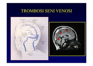 TROMBOSI SENI VENOSI
 