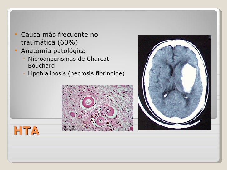 Eupo neuro Hemorragias y trombosis venosas