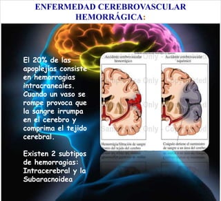ENFERMEDAD CEREBROVASCULAR
HEMORRÁGICA:
El 20% de las
apoplejías consiste
en hemorragias
intracraneales.
Cuando un vaso se
rompe provoca que
la sangre irrumpa
en el cerebro y
comprima el tejido
cerebral.
Existen 2 subtipos
de hemorragias:
Intracerebral y la
Subaracnoidea
 
