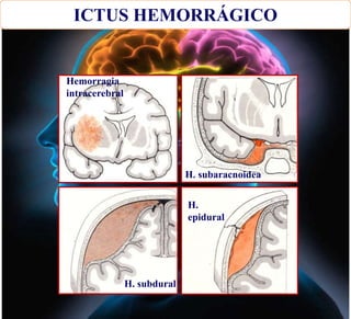 ICTUS HEMORRÁGICO
Hemorragia
intracerebral
H. subaracnoidea
H. subdural
H.
epidural
 