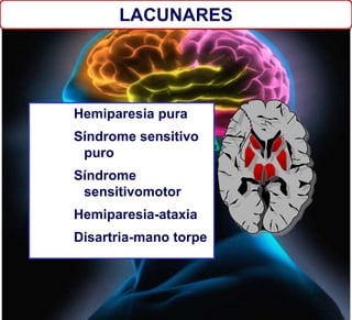 Hemiparesia pura
Síndrome sensitivo
puro
Síndrome
sensitivomotor
Hemiparesia-ataxia
Disartria-mano torpe
LACUNARES
 