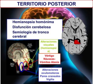 Hemianopsia homónima
Disfunción cerebelosa
Semiología de tronco
cerebral
TERRITORIO POSTERIOR
Alteraciones
visuales
(hemianopsi
a)
Vértigo
Náuseas-
Vómitos Ataxia
Alteraciones
oculomotoras
Pares craneales
Vigilia
 