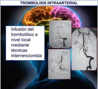 Infusión del
trombolítico a
nivel local
mediante
técnicas
intervencionista
s
TROMBOLISIS INTRAARTERIAL
 