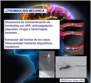 Situaciones de contraindicación de
trombolisis con rtPA: anticoagulación,
plaquetas, cirugia o hemorragias
recientes,…
Extracción del trombo de los vasos
intracraneales mediante dispositivos
mecánicos.
TROMBOLISIS MECÁNICA
MERCI trial. Stroke 2005
 