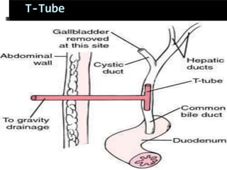 T-Tube
 
