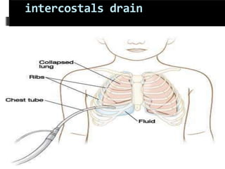 intercostals drain
 