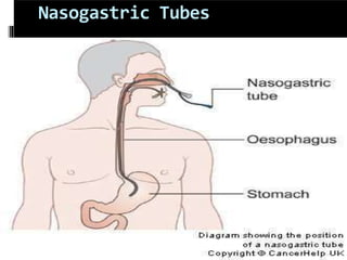 Nasogastric Tubes
 