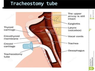 Tracheostomy tube
 