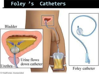 Foley ’s Catheters
 