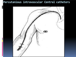 Percutanious intravascular Central catheters
 