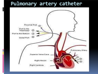 Pulmonary artery catheter
 