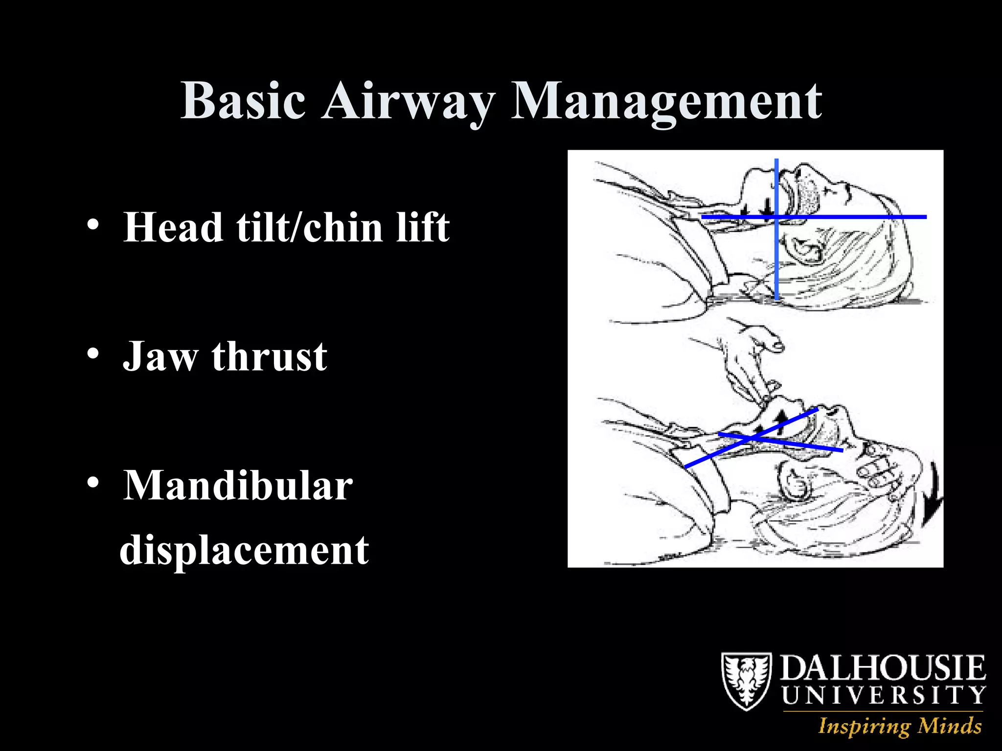 Basic Airway Management Head tilt/chin lift Jaw thrust Mandibular displacement 