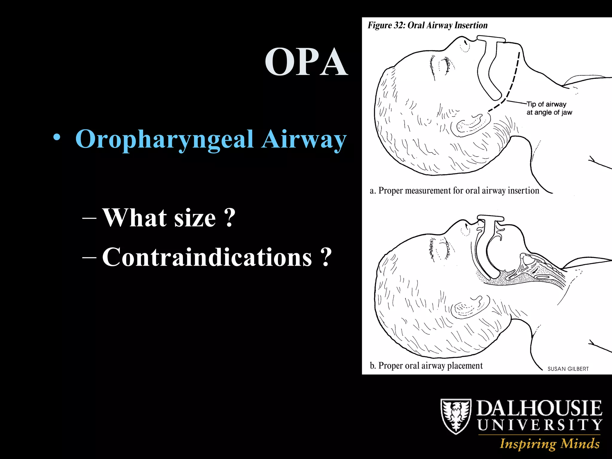 OPA Oropharyngeal Airway What size ? Contraindications ? 