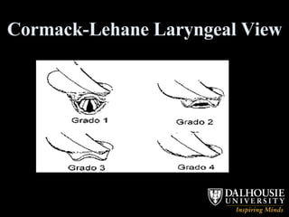 Cormack-Lehane Laryngeal View 