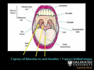 3 sprays of lidocaine to each location + 3 sprays behind tongue 