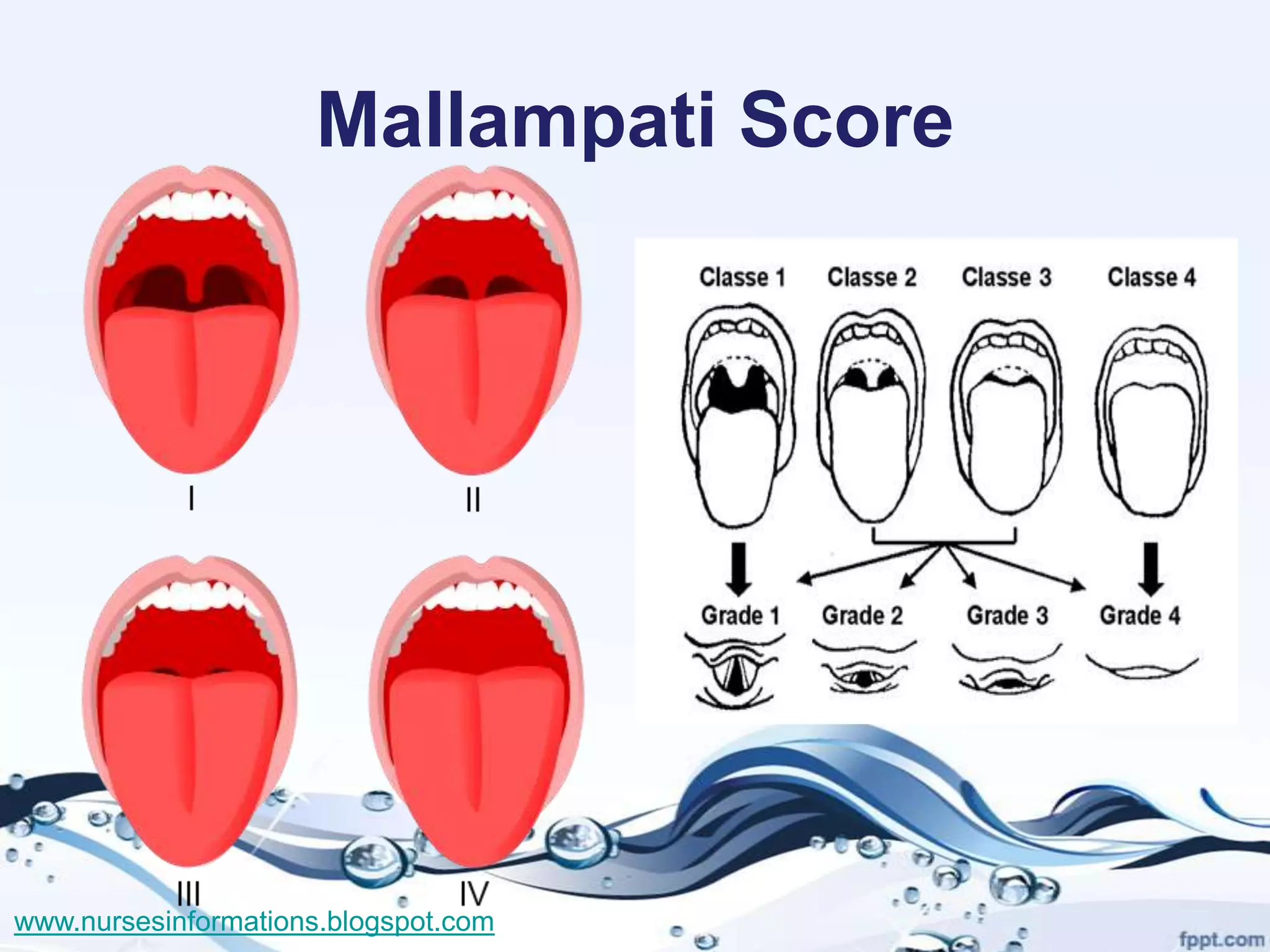 Mallampati Score




www.nursesinformations.blogspot.com
 