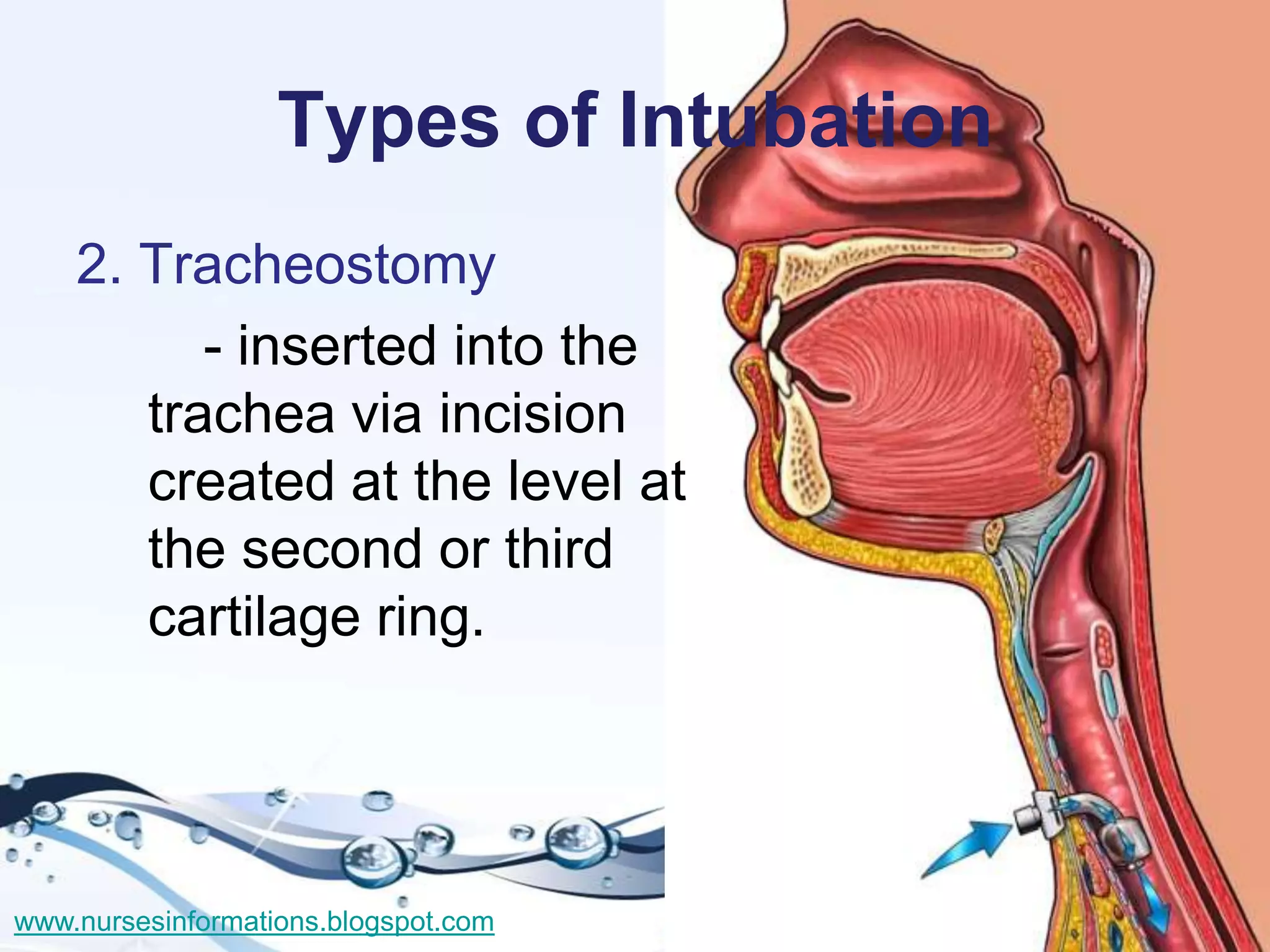 Types of Intubation
    2. Tracheostomy
          - inserted into the
       trachea via incision
       created at the level at
       the second or third
       cartilage ring.




www.nursesinformations.blogspot.com
 