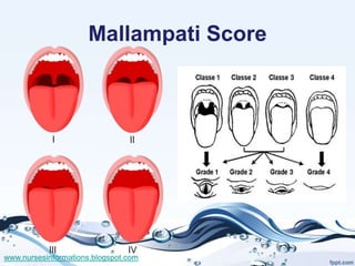 Mallampati Score




www.nursesinformations.blogspot.com
 