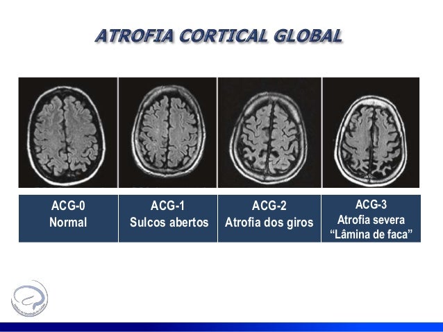 I curso neuroimagem demencias.st