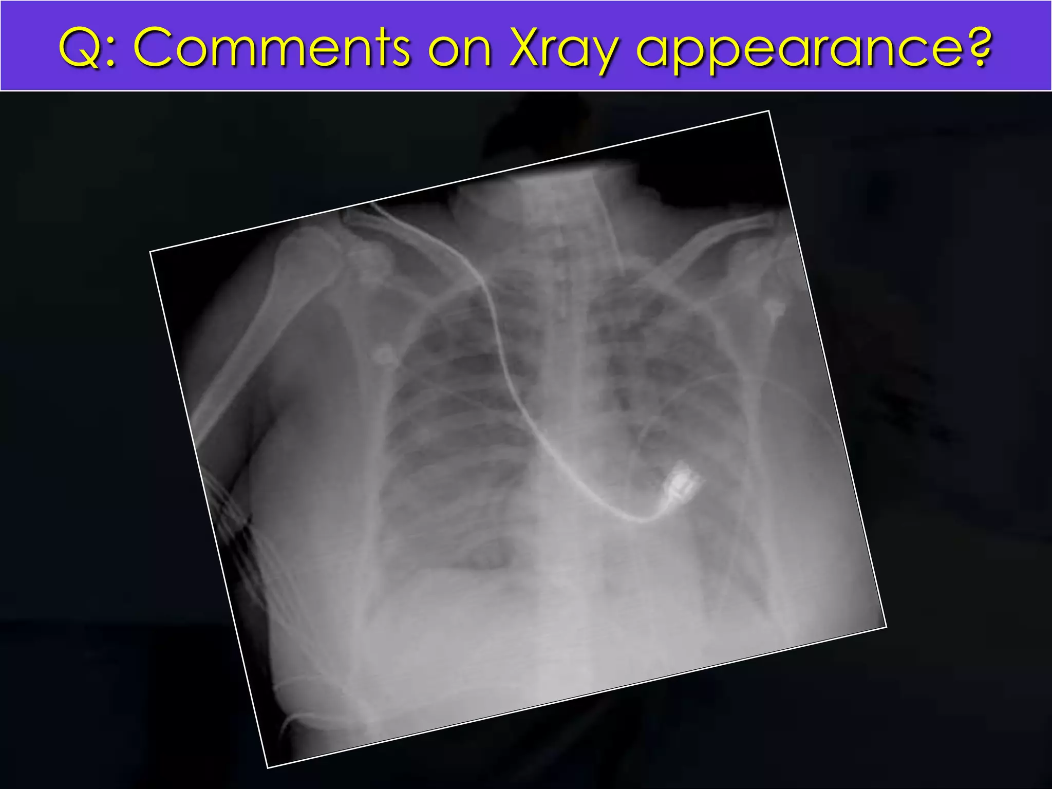 Systolic blood pressure < 90 mm Hg 