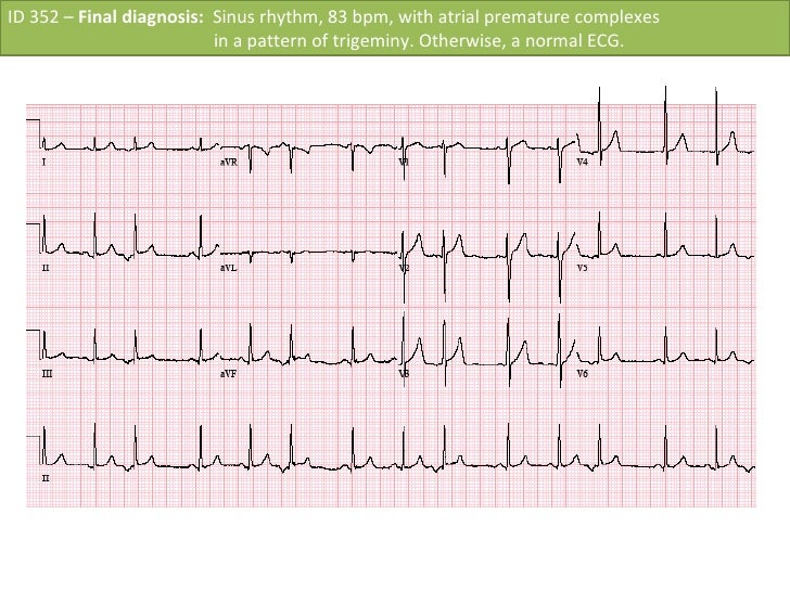 Id 352 Sinus Rhythm With Premature Atrial Complex Id 352 Sinus Rhythm With Premature Atrial Complex