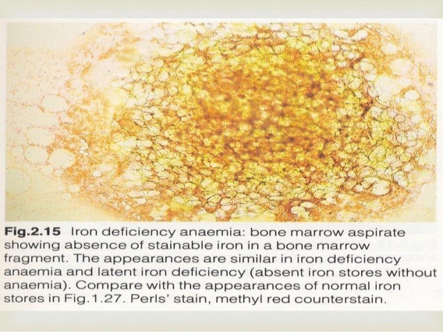 Iron deficiency anemia