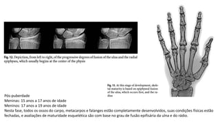 Pós-puberdade
Meninas: 15 anos a 17 anos de idade
Meninos: 17 anos a 19 anos de idade
Nesta fase, todos os ossos do carpo, metacarpos e falanges estão completamente desenvolvidos, suas condições físicas estão
fechadas, e avaliações de maturidade esquelética são com base no grau de fusão epifisária da ulna e do rádio.
 