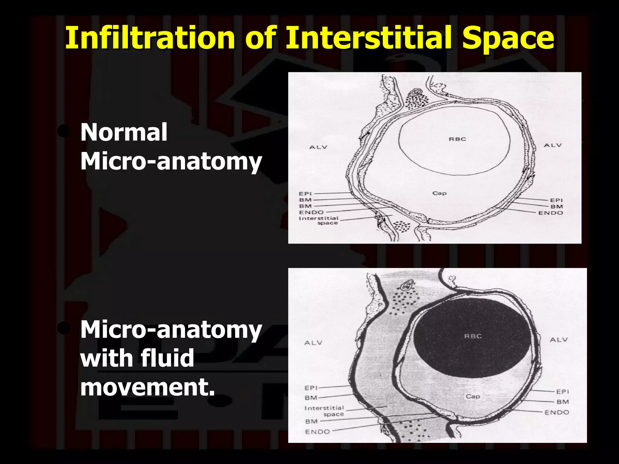 Infiltration of Interstitial Space Normal  Micro-anatomy Micro-anatomy with fluid movement. 