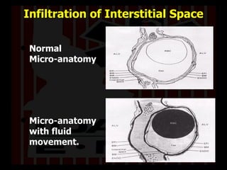 Infiltration of Interstitial Space Normal  Micro-anatomy Micro-anatomy with fluid movement. 