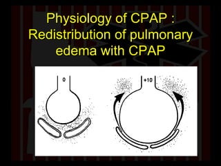 Physiology of CPAP : Redistribution of pulmonary edema with CPAP 