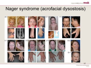 Nager syndrome (acrofacial dysostosis)
17