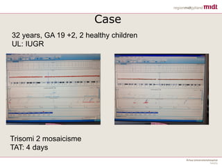 32 years, GA 19 +2, 2 healthy children
UL: IUGR
Trisomi 2 mosaicisme
TAT: 4 days
Case